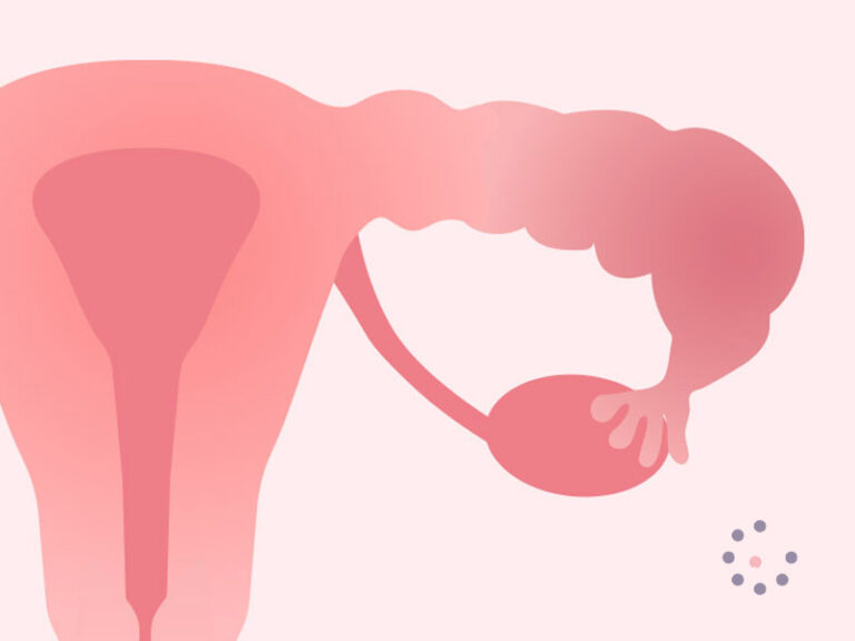 ¿Cómo amenaza el hidrosálpinx a la fertilidad? Clínica Tambre