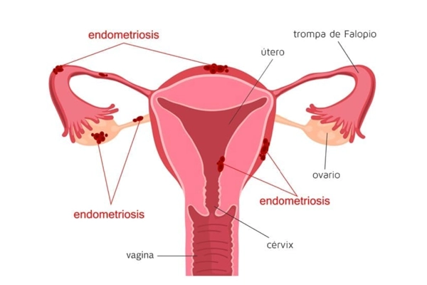 Endometriosis diagnóstico en Tambre